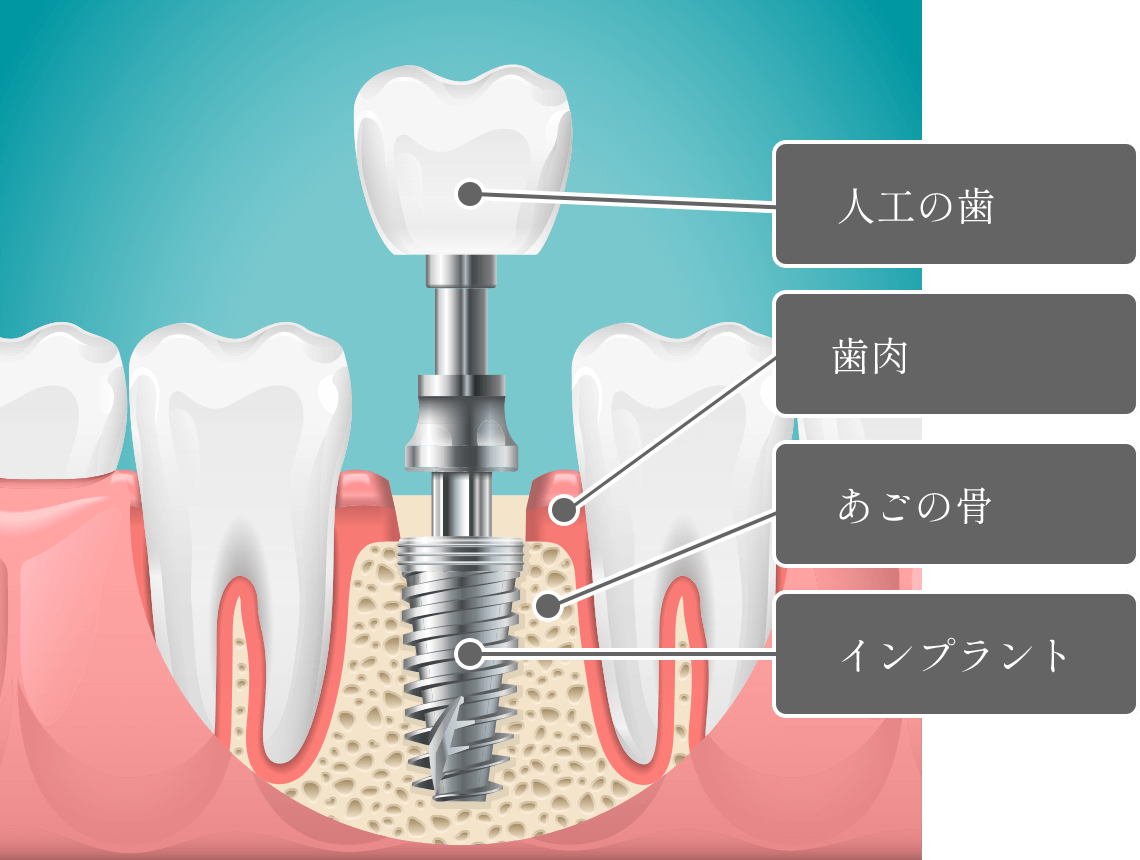 インプラントの構造のイラスト1