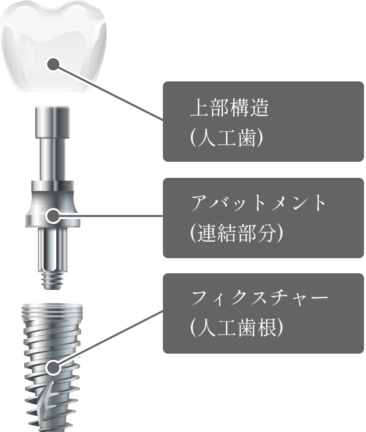 インプラントの構造のイラスト2