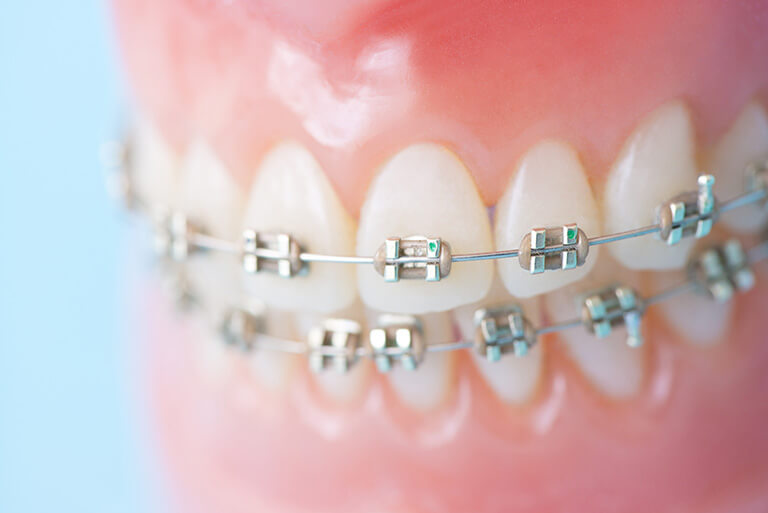 矯正治療について