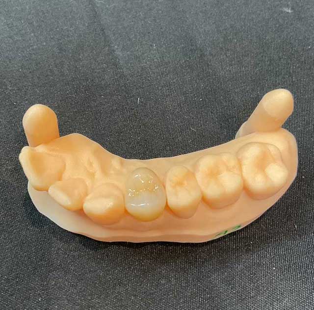 e-maxFULL（セラミック）