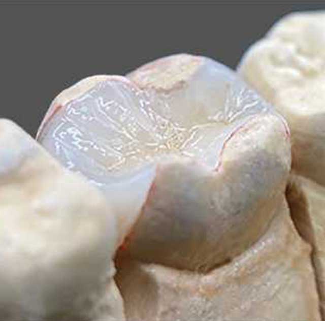 e-maxインレー（セラミック）