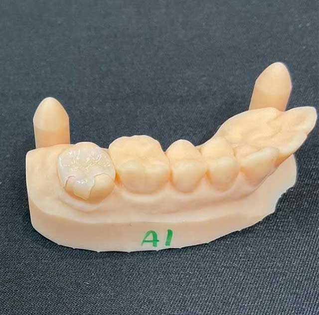 ジルコニアインレー